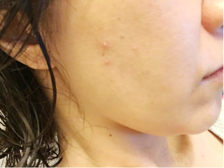 ノンコメドジェニックオイルの肌への影響