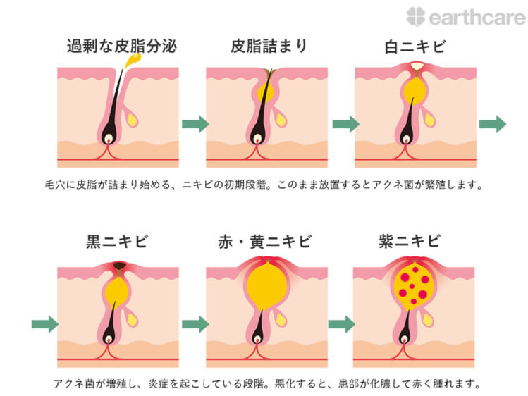 1. 皮脂分泌、毛穴のつまり、アクネ菌がニキビの原因だと知っていますか？