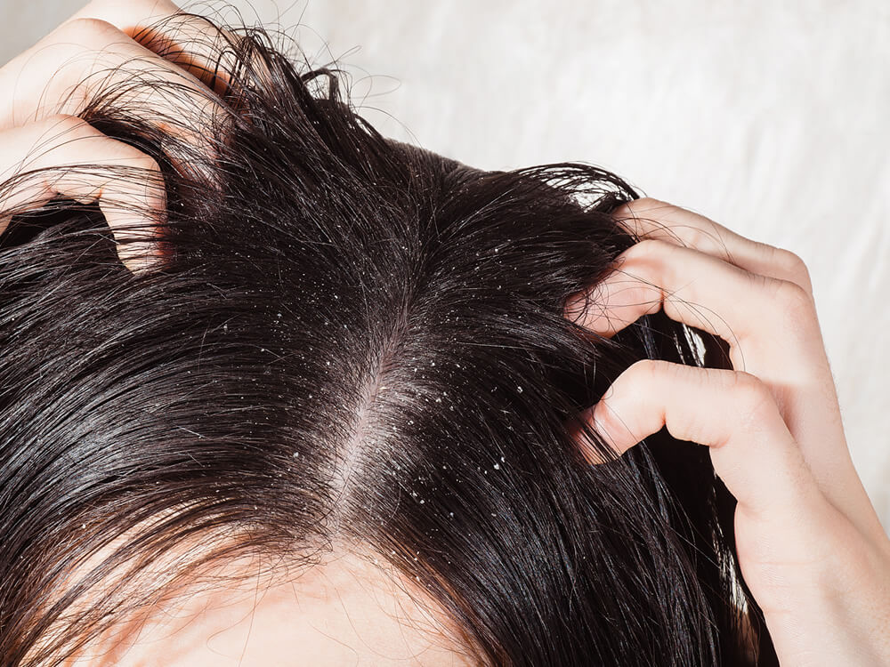 頭皮のトラブル原因と対策