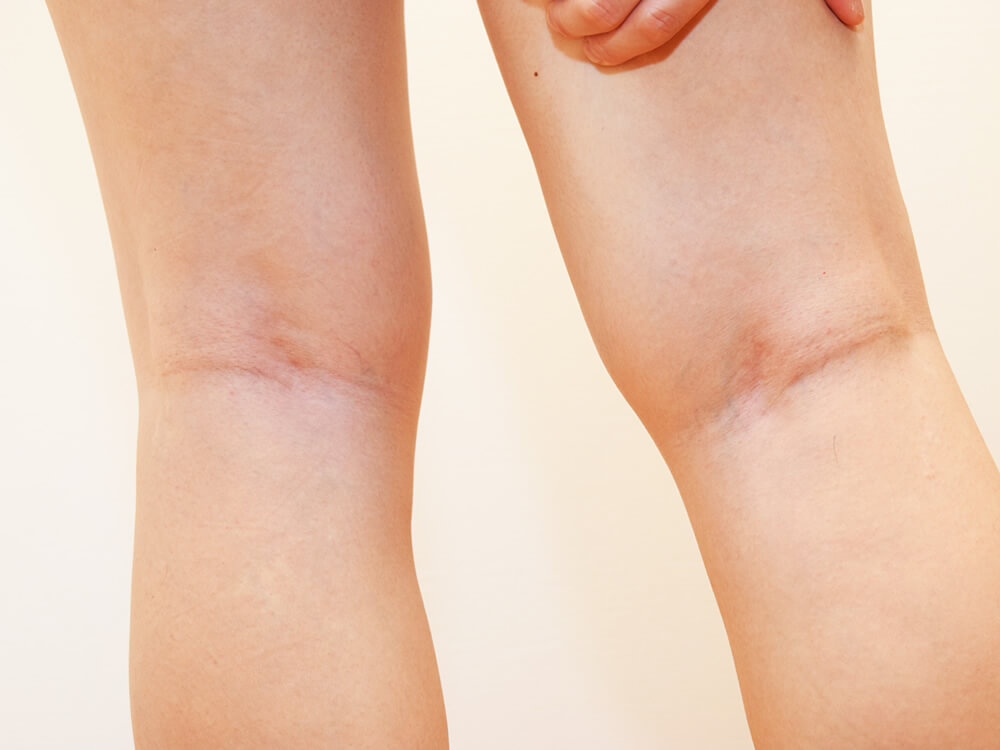 膝裏がかゆいときの原因と対処法とは 何度も繰り返す湿疹 皮膚炎を治したい
