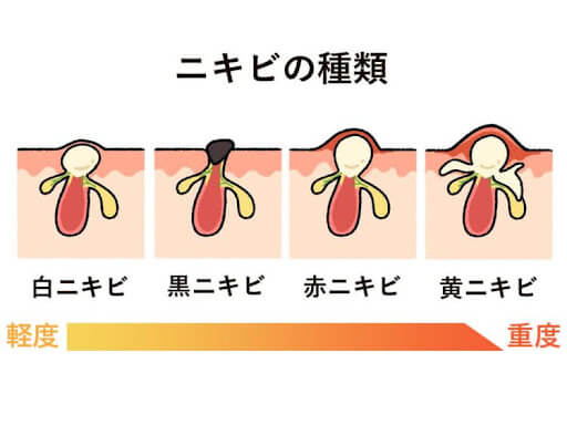 ニキビの種類